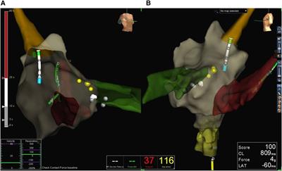 Zero fluoroscopy ablation for atrioventricular nodal reentrant tachycardia and typical atrial flutter is equally safe and effective with EnSite NavX, Carto3, and Rhythmia mapping systems